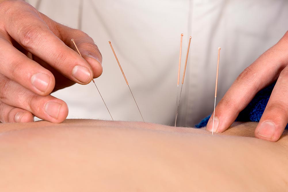 Acupunctuur behandeling TCM klniniek Shnzhou Amsterdam