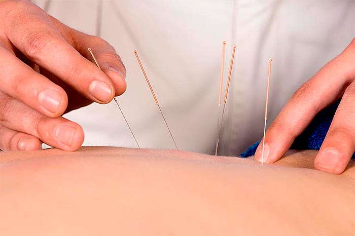 Acupuncture in TCM clinic Amsterdam - CMC Tasly Group