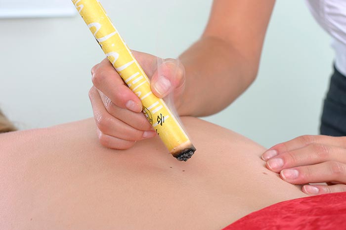 Moxa therapy with acupuncture needles - TCM en Acupunctuurkliniek Amsterdam-Chinese Medical Center