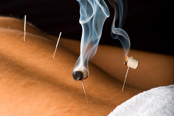 Moxatherapie-TCM en Acupunctuurkliniek Amsterdam-Chinese Medical Center